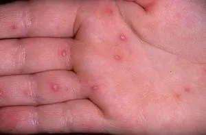 Бульбашки на шкірі з рідиною лікування (шкірі) Бульбашки на шкірі з рідиною лікування