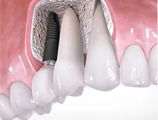 Протезування зубів в Запоріжжі бюгельні і знімні протези при повній відсутності зубів, (коронки діоксиду цирконію металокераміки ціни) Протезування зубів в Запоріжжі бюгельні і знімні протези при повній відсутності зубів,
