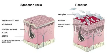 Псоріаз причини, клінічні ознаки, лікування і профілактика захворювання (захворювання) Псоріаз причини, клінічні ознаки, лікування і профілактика захворювання