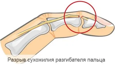 Розрив сухожилля розгинача пальця - лікування (сухожилля) Розрив сухожилля розгинача пальця - лікування