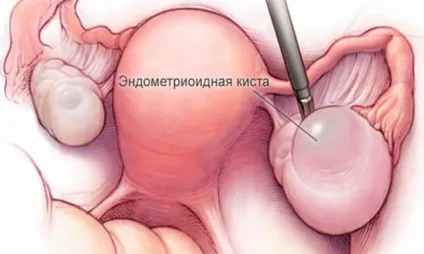 Розрив кісти яєчника симптоми, причини, наслідки (яєчника) Розрив кісти яєчника симптоми, причини, наслідки