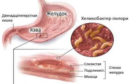 Розлад травлення причини порушення, симптоми, лікування