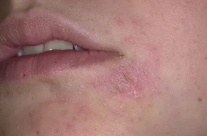 Роздратування навколо рота основні причини та способи лікування
