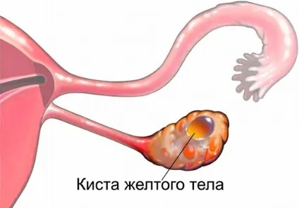 Розрив кісти яєчника симптоми, причини, наслідки (розрив) Розрив кісти яєчника симптоми, причини, наслідки