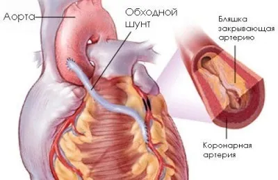 Рубцеві зміни на ЕКГ симптоми і ознаки (зміни) Рубцеві зміни на ЕКГ симптоми і ознаки