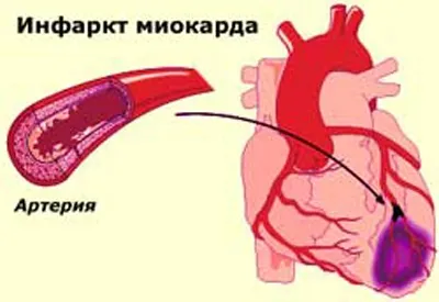 Рубцеві зміни на ЕКГ симптоми і ознаки (рубцеві) Рубцеві зміни на ЕКГ симптоми і ознаки