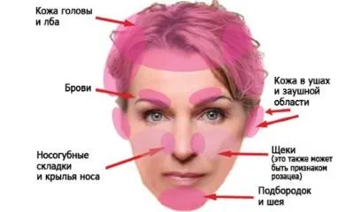 Себорейний псоріаз фото, лікування, себорейний псоріаз волосистої частини голови, себорейний псоріаз (фото) Себорейний псоріаз фото, лікування, себорейний псоріаз волосистої частини голови, себорейний псоріаз