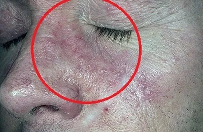 Себорейний псоріаз що це таке, як лікувати і які основні відмінності (волосистої частини голови) Себорейний псоріаз що це таке, як лікувати і які основні відмінності