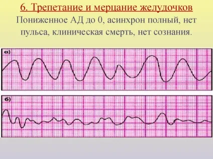 Серцево-судинна система гіпертонія - гіпертонія, захворювання серцево-судинної системи (серцево-судинної) Серцево-судинна система гіпертонія - гіпертонія, захворювання серцево-судинної системи