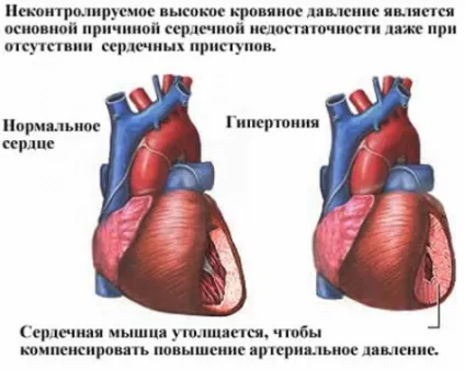 Серцевий кашель причини, симптоми, лікування (кашель) Серцевий кашель причини, симптоми, лікування