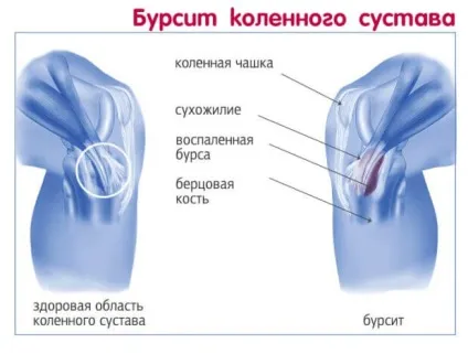 Шишка на коліні - причини і лікування (коліні) Шишка на коліні - причини і лікування