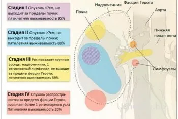 Симптоми, які можуть з'явитися через рак нирок (які) Симптоми, які можуть з'явитися через рак нирок
