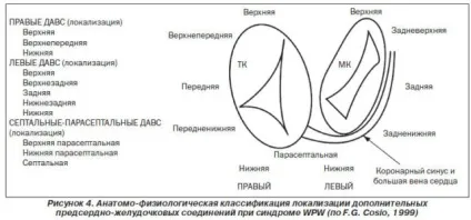Синдром Вольфа - Паркінсона