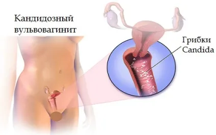 Симптоми і основні методи лікування кандидозного вульвовагініту (кандидозного) Симптоми і основні методи лікування кандидозного вульвовагініту