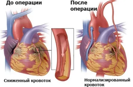 Шунтування серця що це таке аортокоронарне шунтування (шунтування) Шунтування серця що це таке аортокоронарне шунтування