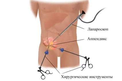 симптоми апендициту