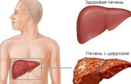 Скільки живуть алкоголіки тривалість і якість життя (живуть) Скільки живуть алкоголіки тривалість і якість життя