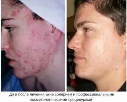 Солярій від прищів, плям на обличчі і спині чи можна з прищами хоч в солярій, чому з'явилися прищі (спині) Солярій від прищів, плям на обличчі і спині чи можна з прищами хоч в солярій, чому з'явилися прищі