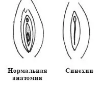 Зрощення малих статевих губ - причини, симптоми, діагностика та лікування (симптоми) Зрощення малих статевих губ - причини, симптоми, діагностика та лікування