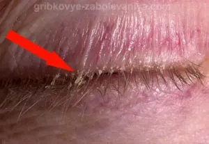 Сухий себорейний дерматит причини, симптоми, лікування