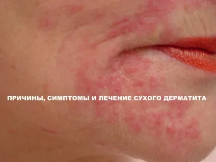 Сухий дерматит причини виникнення та способи лікування (причини) Сухий дерматит причини виникнення та способи лікування