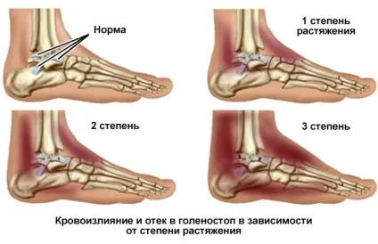 Травму гомілкостопа (гомілковостопного суглоба)