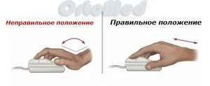 Тунельний синдром зап'ястя лікування, синдром карпального каналу (тунельний) Тунельний синдром зап'ястя лікування, синдром карпального каналу