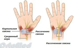 Тунельний синдром зап'ястя лікування, синдром карпального каналу (синдром) Тунельний синдром зап'ястя лікування, синдром карпального каналу