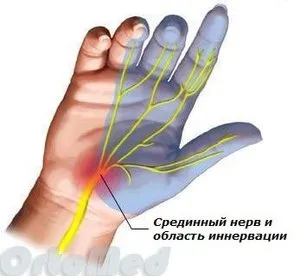 Тунельний синдром зап'ястя лікування, синдром карпального каналу (тунельний) Тунельний синдром зап'ястя лікування, синдром карпального каналу