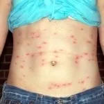 Укус комара - як зняти набряк в домашніх умовах лікування комариних укусів, червоних плям, пухирів (комара) Укус комара - як зняти набряк в домашніх умовах лікування комариних укусів, червоних плям, пухирів