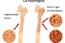 Ударно-хвильова терапія ефективність методу (терапія) Ударно-хвильова терапія ефективність методу