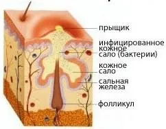 Угри на підборідді у жінок причини, як позбутися (як позбутися від вугрів на підборідді) Угри на підборідді у жінок причини, як позбутися