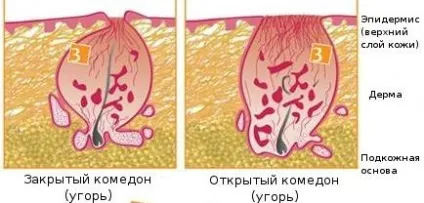 Угри на підборідді у жінок причини, як позбутися (вугри на підборідді у жінок) Угри на підборідді у жінок причини, як позбутися