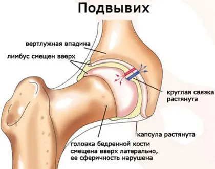 Удар тазостегнового суглоба симптоми і лікування наслідки травми суглоба стегна (симптоми) Удар тазостегнового суглоба симптоми і лікування наслідки травми суглоба стегна