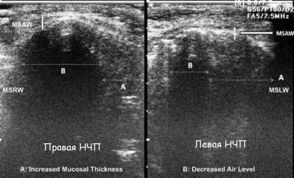 Узі пазух носа (лекція на діагностере) (лекція) Узі пазух носа (лекція на діагностере)