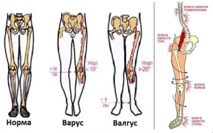 Вальгусное викривлення ніг у дитини причини і лікування (дитини) Вальгусное викривлення ніг у дитини причини і лікування