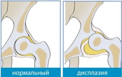 Вальгусное викривлення ніг у дитини причини і лікування (викривлення) Вальгусное викривлення ніг у дитини причини і лікування