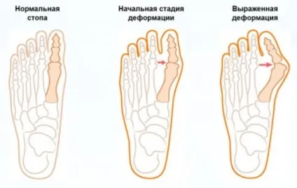 Вальгусное викривлення ніг у дитини причини і лікування (викривлення) Вальгусное викривлення ніг у дитини причини і лікування