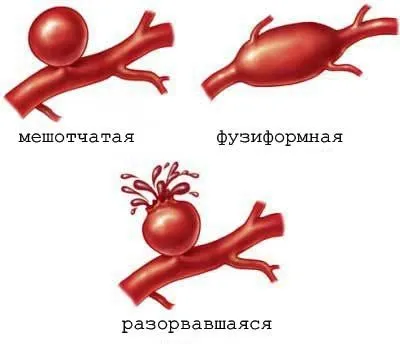 Аневризма причини виникнення, ознаки, симптоми, лікування і профілактика патології (аневризма головного мозку) Аневризма причини виникнення, ознаки, симптоми, лікування і профілактика патології