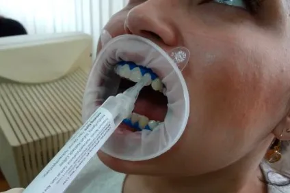 Amazing white відбілювання суть методики, техніка проведення (відбілювання зубів amazing white) Amazing white відбілювання суть методики, техніка проведення