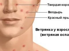 Вітрянка, хвороба у дорослих, симптоми, перебіг, можливі ускладнення