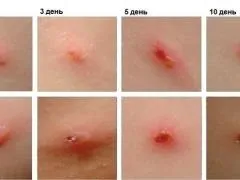 Вітрянка, хвороба у дорослих, симптоми, перебіг, можливі ускладнення