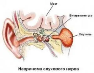 Вестибулярний неврит симптоми і лікування (симптоми) Вестибулярний неврит симптоми і лікування