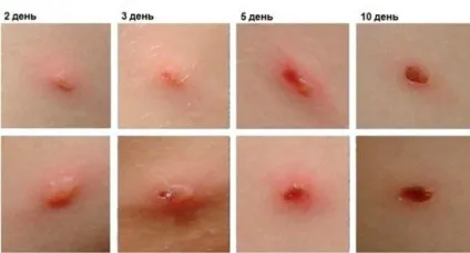Вітрянка, хвороба у дорослих, симптоми, перебіг, можливі ускладнення