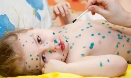 Вітрянка симптоми і лікування (симптоми) Вітрянка симптоми і лікування