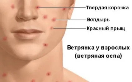 Вітрянка, хвороба у дорослих, симптоми, перебіг, можливі ускладнення