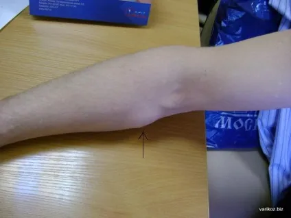 У чому різниця між ліпомою і атеромою і чи потрібно їх видаляти