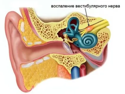 Вестибулярний неврит чому розвивається і як його лікувати