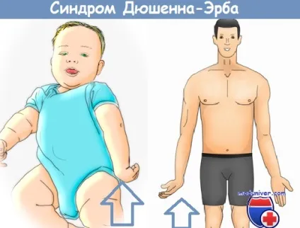 Верхній парапарез у дітей