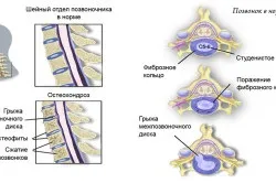 Види масажерів, корисних при остеохондрозі (усунути больові відчуття) Види масажерів, корисних при остеохондрозі